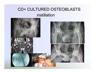 CD+ CULTURED OSTEOBLASTS
instillation

 