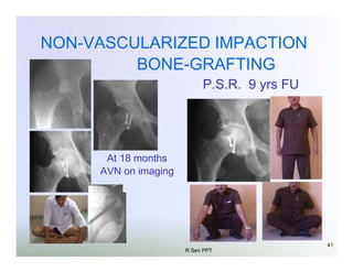 NON-VASCULARIZED IMPACTION
BONE-GRAFTING
P.S.R. 9 yrs FU

At 18 months
AVN on imaging

R Sen PPT

41

 