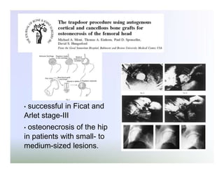 successful in Ficat and
Arlet stage-III
•

osteonecrosis of the hip
in patients with small- to
medium-sized lesions.
•

 