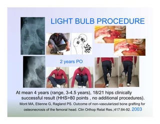 LIGHT BULB PROCEDURE

2 years PO

At mean 4 years (range, 3-4.5 years), 18/21 hips clinically
successful result (HHS>80 points , no additional procedures).
Mont MA, Etienne G, Ragland PS. Outcome of non-vascularized bone grafting for
osteonecrosis of the femoral head. Clin Orthop Relat Res.;417:84-92. 2003

 
