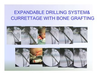 EXPANDABLE DRILLING SYSTEM&
CURRETTAGE WITH BONE GRAFTING

 
