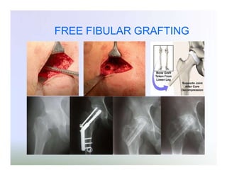 FREE FIBULAR GRAFTING

 