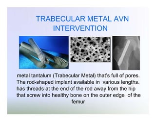 TRABECULAR METAL AVN
INTERVENTION

metal tantalum (Trabecular Metal) that’s full of pores.
The rod-shaped implant available in various lengths.
has threads at the end of the rod away from the hip
that screw into healthy bone on the outer edge of the
femur

 