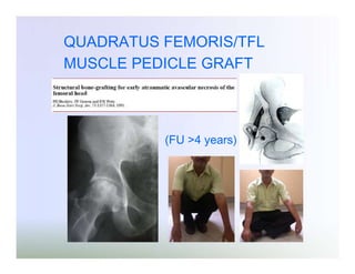 QUADRATUS FEMORIS/TFL
MUSCLE PEDICLE GRAFT

(FU >4 years)

 