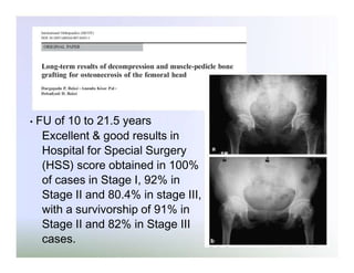 •

FU of 10 to 21.5 years
Excellent & good results in
Hospital for Special Surgery
(HSS) score obtained in 100%
of cases in Stage I, 92% in
Stage II and 80.4% in stage III,
with a survivorship of 91% in
Stage II and 82% in Stage III
cases.

 