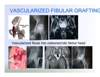VASCULARIZED FIBULAR GRAFTING

Vascularized fibula into osteonecrotic femur head

 