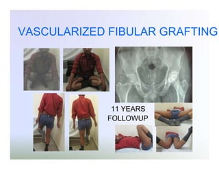 VASCULARIZED FIBULAR GRAFTING

11 YEARS
FOLLOWUP

 