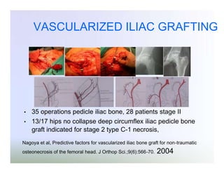 VASCULARIZED ILIAC GRAFTING

•
•

35 operations pedicle iliac bone, 28 patients stage II
13/17 hips no collapse deep circumflex iliac pedicle bone
graft indicated for stage 2 type C-1 necrosis,

Nagoya et al, Predictive factors for vascularized iliac bone graft for non-traumatic
osteonecrosis of the femoral head. J Orthop Sci.;9(6):566-70.

2004

 
