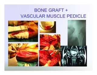 BONE GRAFT +
VASCULAR MUSCLE PEDICLE

 