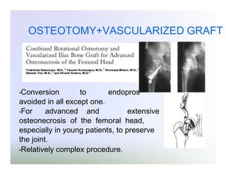 OSTEOTOMY+VASCULARIZED GRAFT

•Conversion

to
endopros
avoided in all except one.
•For
advanced and
extensive
osteonecrosis of the femoral head,
especially in young patients, to preserve
the joint.
•Relatively complex procedure.

 