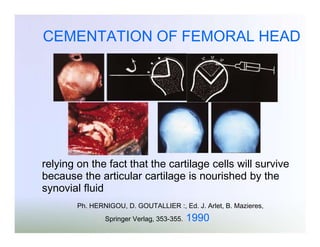 CEMENTATION OF FEMORAL HEAD

relying on the fact that the cartilage cells will survive
because the articular cartilage is nourished by the
synovial fluid
Ph. HERNIGOU, D. GOUTALLIER :, Ed. J. Arlet, B. Mazieres,
Springer Verlag, 353-355.

1990

 