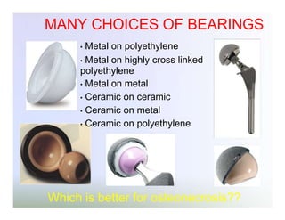 MANY CHOICES OF BEARINGS
Metal on polyethylene
• Metal on highly cross linked
polyethylene
• Metal on metal
• Ceramic on ceramic
• Ceramic on metal
• Ceramic on polyethylene
•

Which is better for osteonecrosis??

 