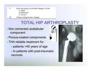 TOTAL HIP ARTHROPLASTY
•

Non cemented acetabular
component

•

Porous-coated components

•

THA reliable treatment for
- patients >45 years of age
- In patients with post-traumatic
necrosis

 