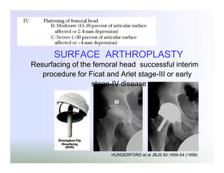 SURFACE ARTHROPLASTY

Resurfacing of the femoral head successful interim
procedure for Ficat and Arlet stage-III or early
stage-IV disease

HUNGERFORD et al JBJS 80:1656-64 (1998)

 
