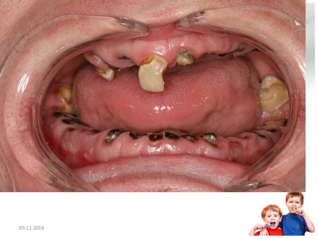 rampant caries and chemico machanical removal of caries rampant caries