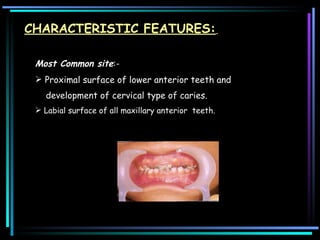 CHARACTERISTIC FEATURES:   Most Common site :-  Proximal surface of lower anterior teeth and development of cervical type of caries.  Labial surface of all maxillary anterior  teeth.  