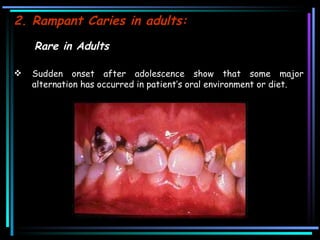 2. Rampant Caries in adults:   Rare in Adults Sudden onset after adolescence show that some major alternation has occurred in patient’s oral environment or diet. 