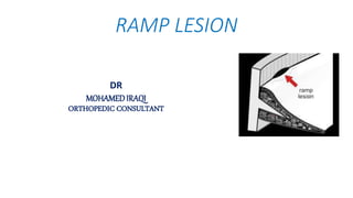 DR
MOHAMEDIRAQI
ORTHOPEDIC CONSULTANT
RAMP LESION
 