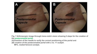 Ramp lesion | PPTX