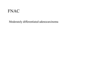 FNAC
Moderately differentiated adenocarcinoma
 
