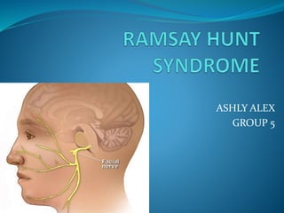 Ramsay Hunt syndrome - ScienceDirect