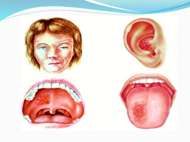 Ramsay hunt syndrome
