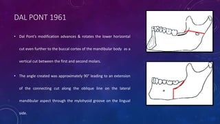DAL PONT 1961
• Dal Pont’s modification advances & rotates the lower horizontal
cut even further to the buccal cortex of the mandibular body as a
vertical cut between the first and second molars.
• The angle created was approximately 90° leading to an extension
of the connecting cut along the oblique line on the lateral
mandibular aspect through the mylohyoid groove on the lingual
side.
 