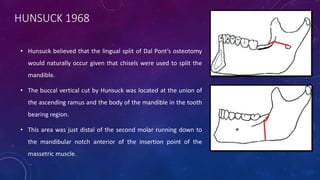 HUNSUCK 1968
• Hunsuck believed that the lingual split of Dal Pont’s osteotomy
would naturally occur given that chisels were used to split the
mandible.
• The buccal vertical cut by Hunsuck was located at the union of
the ascending ramus and the body of the mandible in the tooth
bearing region.
• This area was just distal of the second molar running down to
the mandibular notch anterior of the insertion point of the
massetric muscle.
 