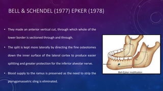 BELL & SCHENDEL (1977) EPKER (1978)
• They made an anterior vertical cut, through which whole of the
lower border is sectioned through and through.
• The split is kept more laterally by directing the fine osteotomes
down the inner surface of the lateral cortex to produce easier
splitting and greater protection for the inferior alveolar nerve.
• Blood supply to the ramus is preserved as the need to strip the
pterygomassetric sling is eliminated.
 