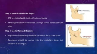 Step 3: Identification of the lingula
• OPG is a helpful guide in identification of lingula
• If the lingula cannot be identified, the ridge should be reduced with
a bur.
Step 4: Medial Ramus Osteotomy
• Angulation of osteotomy should be parallel to the occlusal plane.
• Osteotomy should be carried into the medullary bone, just
posterior to the lingula.
 