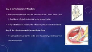 Step 5: Vertical section of Osteotomy
• The osteotomy extends into the medullary bone ( about 5 mm ) and
it should end inferiorly just mesial to the second molar.
• If impacted tooth is present, the osteotomy should include the tooth
Step 6: Buccal osteotomy of the mandibular Body
• It begins at the lower border and is joined superiorly with the vertical
ramus osteotomy
 