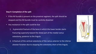 Step 9: Completion of the split
• If the NV bundle is present on the proximal segment, the split should be
stopped and the NV bundle must be carefully dissected
• Any resistance in the split could be due
1. A greenstick fracture of the bone in which the lower border starts
fracturing superiorly toward the distal part of the medial ramus
osteotomy, posterior to the lingula.
2. A fracture of the vertical osteotomy of the ramus anterior to the inferior
alveolar foramen due to stopping the osteotomy short of the lingula.
 