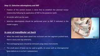 Step 11: Selective odontoplasty and IMF
• Fixation of the central incisors is done first to establish the planned incisor
relationship following by application of IMF to the posterior teeth.
• An acrylic splint can be used.
• Selective odontoplasty should be performed prior to IMF if indicated in the
model surgery.
In case of mandibular set back
• When the teeth have been wired into occlusion and the segment pushed back,
there is bony over lap anteriorly.
• This overlapping bone should be removed using rotary instruments.
• The small piece of bone can be used as grafts. (in areas such as intersegmental
bone defects or in Le Fort I osteotomies)
 
