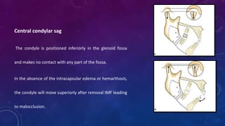 Central condylar sag
The condyle is positioned inferiorly in the glenoid fossa
and makes no contact with any part of the fossa.
In the absence of the intracapsular edema or hemarthosis,
the condyle will move superiorly after removal IMF leading
to malocclusion.
 