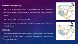 Peripheral condylar sag I
• There is an inferior displacement of the condyle with some contact with
the glenoid fossa with the teeth in temporary IMF and rigid fixation
applied.
• There is no occlusal change in the phase.
• Post-op resorption and subsequent change in condylar shape will lead to
delayed relapse.
Clinical signs
• Difficult to diagnose intra-op because the contact between the condyle &
glenoid fossa supports the occlusion, which may lead to late relapse due to
condylar resorption
 