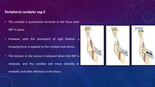 Peripheral condylar sag II
• The condyle is positioned correctly in the fossa with
IMF in place.
• However, with the placement of rigid fixation, a
torquing force is applied to the condyle and ramus.
• The tension in the ramus is released when the IMF is
released, and the condyle will move laterally or
medially and slide inferiorly in the fossa.
 