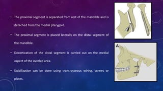 • The proximal segment is separated from rest of the mandible and is
detached from the medial pterygoid.
• The proximal segment is placed laterally on the distal segment of
the mandible.
• Decortication of the distal segment is carried out on the medial
aspect of the overlap area.
• Stabilization can be done using trans-osseous wiring, screws or
plates.
 