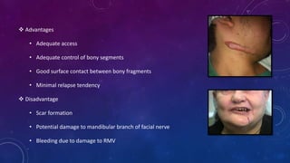  Advantages
• Adequate access
• Adequate control of bony segments
• Good surface contact between bony fragments
• Minimal relapse tendency
 Disadvantage
• Scar formation
• Potential damage to mandibular branch of facial nerve
• Bleeding due to damage to RMV
 