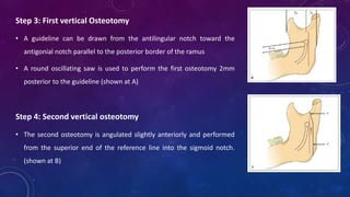 Step 3: First vertical Osteotomy
• A guideline can be drawn from the antilingular notch toward the
antigonial notch parallel to the posterior border of the ramus
• A round oscillating saw is used to perform the first osteotomy 2mm
posterior to the guideline (shown at A)
Step 4: Second vertical osteotomy
• The second osteotomy is angulated slightly anteriorly and performed
from the superior end of the reference line into the sigmoid notch.
(shown at B)
 