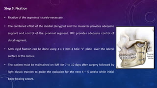 Step 9: Fixation
• Fixation of the segments is rarely necessary.
• The combined effort of the medial pterygoid and the masseter provides adequate
support and control of the proximal segment. IMF provides adequate control of
distal segment.
• Semi rigid fixation can be done using 2 x 2 mm 4 hole “L” plate over the lateral
surface of the ramus.
• The patient must be maintained on IMF for 7 to 10 days after surgery followed by
light elastic traction to guide the occlusion for the next 4 – 5 weeks while initial
bone healing occurs.
 
