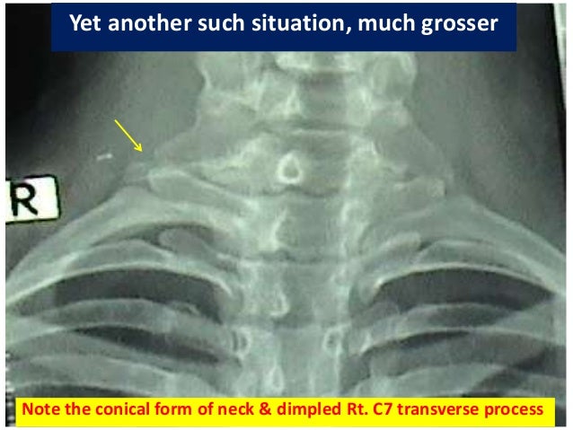 Ramu's sign to clinically elicit lower cervical spinal nerve traction…