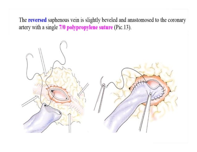 Vector Cabg CABG Bsc nursing | PDF