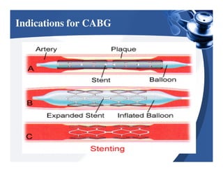 CABG Bsc nursing | PDF