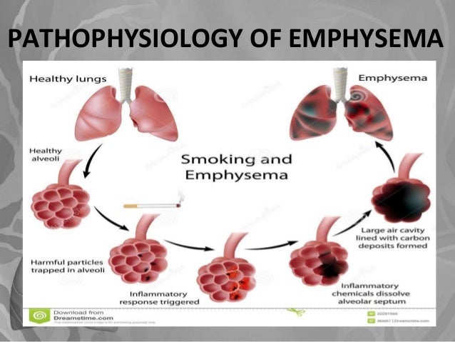 Emphysema
