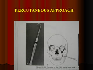 PERCUTANEOUS APPROACH 
 