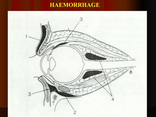 HAEMORRHAGE 
 