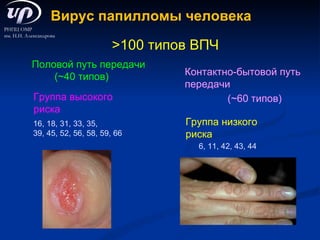 >100  типов  ВПЧ Контактно-бытовой путь передачи (~60  типов ) Половой путь передачи (~40  типов ) Группа высокого риска Группа низкого риска 6, 11, 42, 43, 44 16, 18, 31, 33, 35, 39, 45, 52, 56, 58 , 59, 66 Вирус папилломы человека РНПЦ ОМР  им. Н.Н. Александрова 