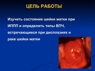 ЦЕЛЬ РАБОТЫ Изучить состояние шейки матки при ИППП и определить типы ВПЧ,  встречающиеся при дисплазиях и  раке шейки матки 