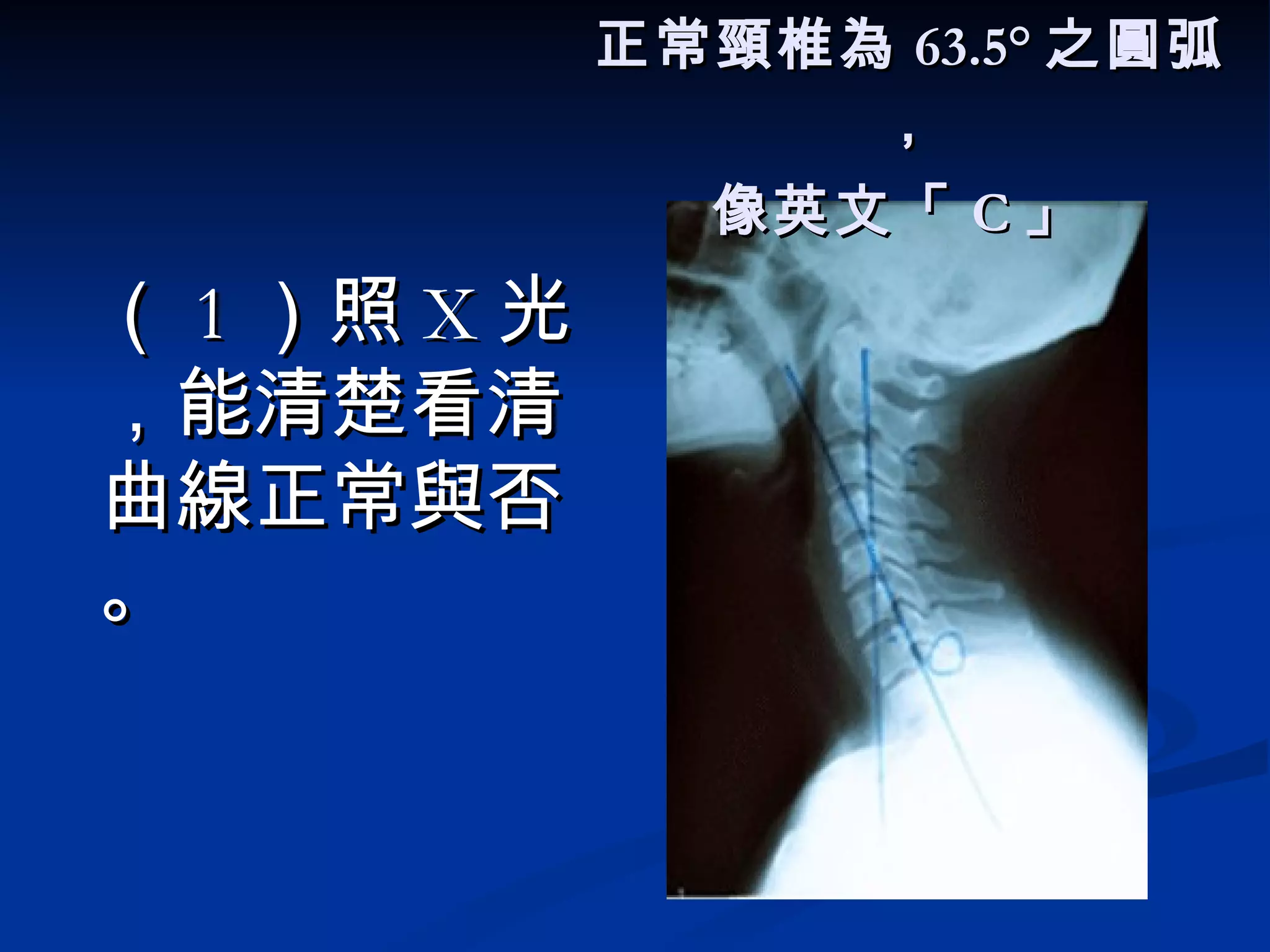 正常頸椎為 63.5° 之圓弧， 像英文「 C 」   （ 1 ）照 X 光，能清楚看清曲線正常與否。 