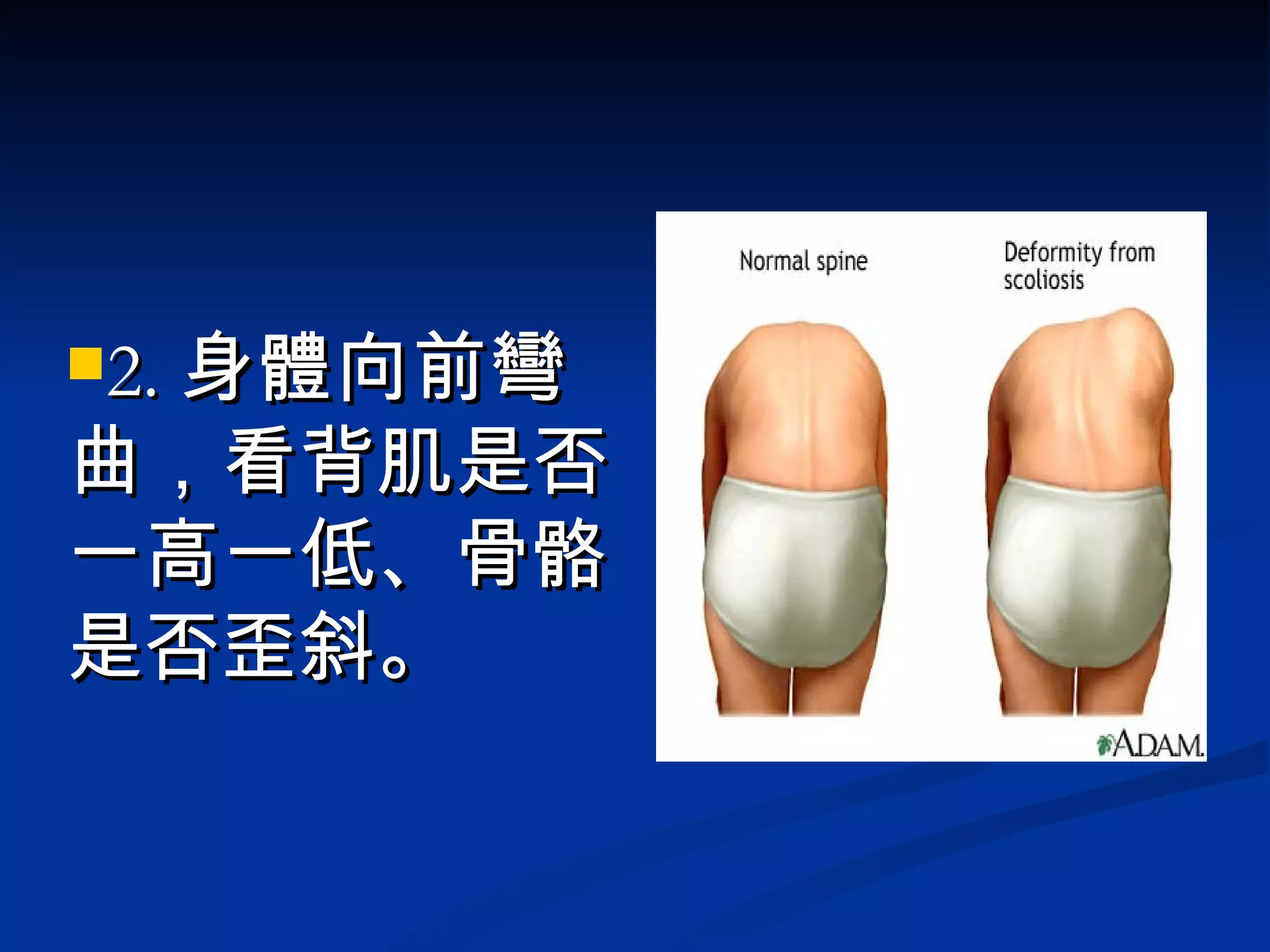 2. 身體向前彎曲，看背肌是否一高一低、骨骼是否歪斜。 